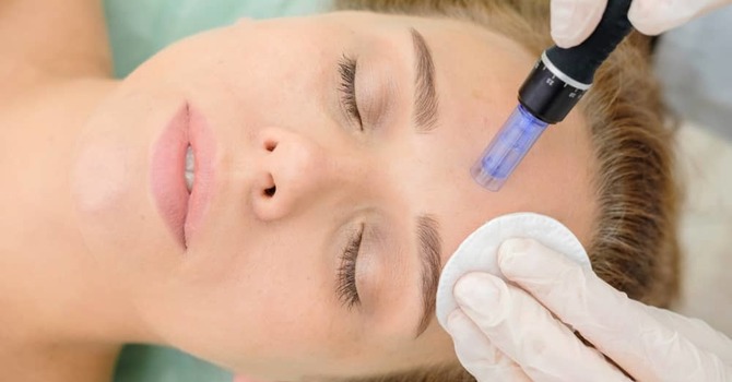 Microneedling